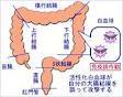 潰瘍性大腸炎1.jpg