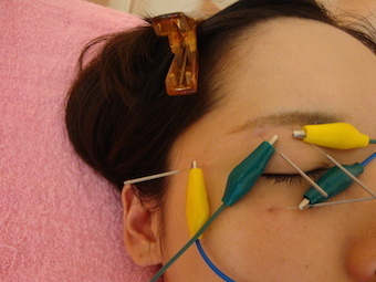 動眼神経麻痺・メジュー症候群