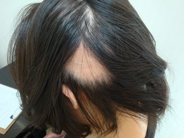 円形脱毛症・脱毛症